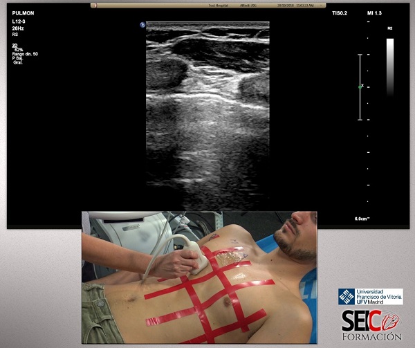 curso ecografia pulmonar Más de 1.700 profesionales participan en el curso online de ecografía pulmonar en la ayuda en el triaje de pacientes con COVID19 Estudiar en Universidad Privada Madrid